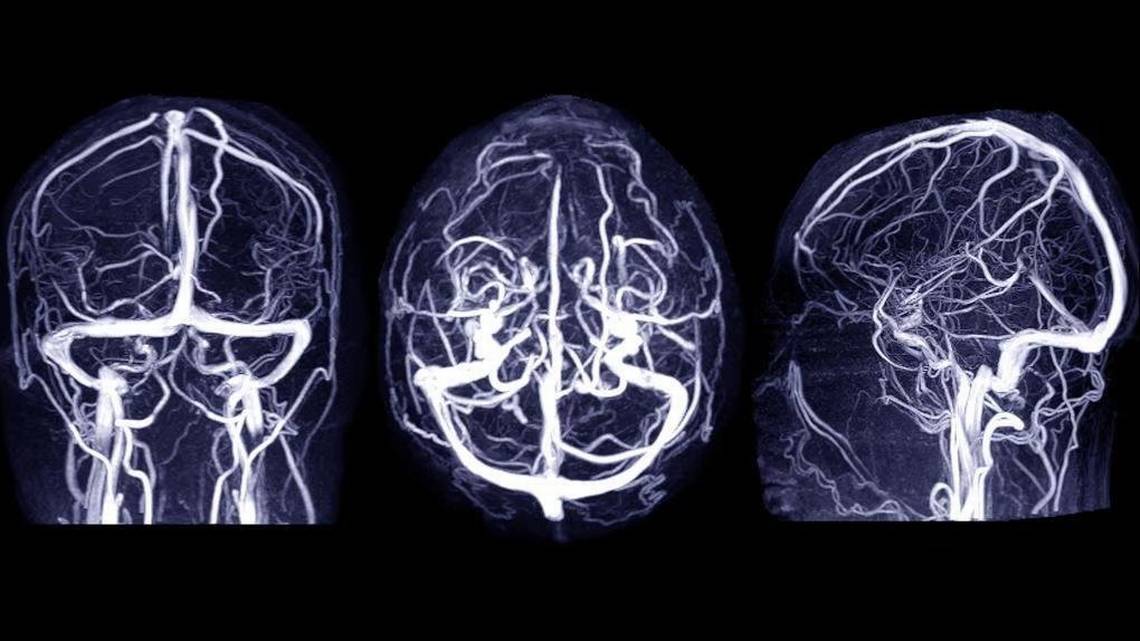 New technique might better treat hematoma brain bleeds