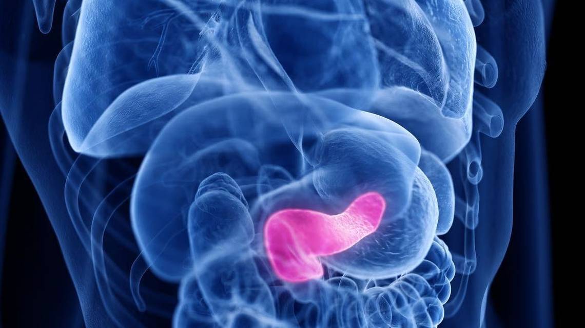 Rise of pancreatic cancer diagnoses might reflect increased early detection